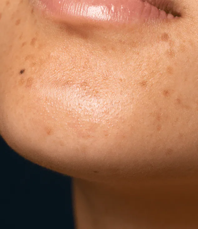 Close view of a cheek and chin with scattered sun spots and freckles