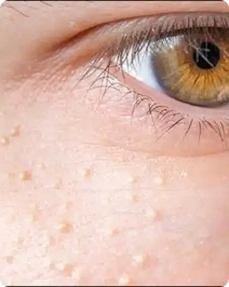 Close view of an eye with small, firm, flesh-coloured bumps on the lower eyelid and cheek