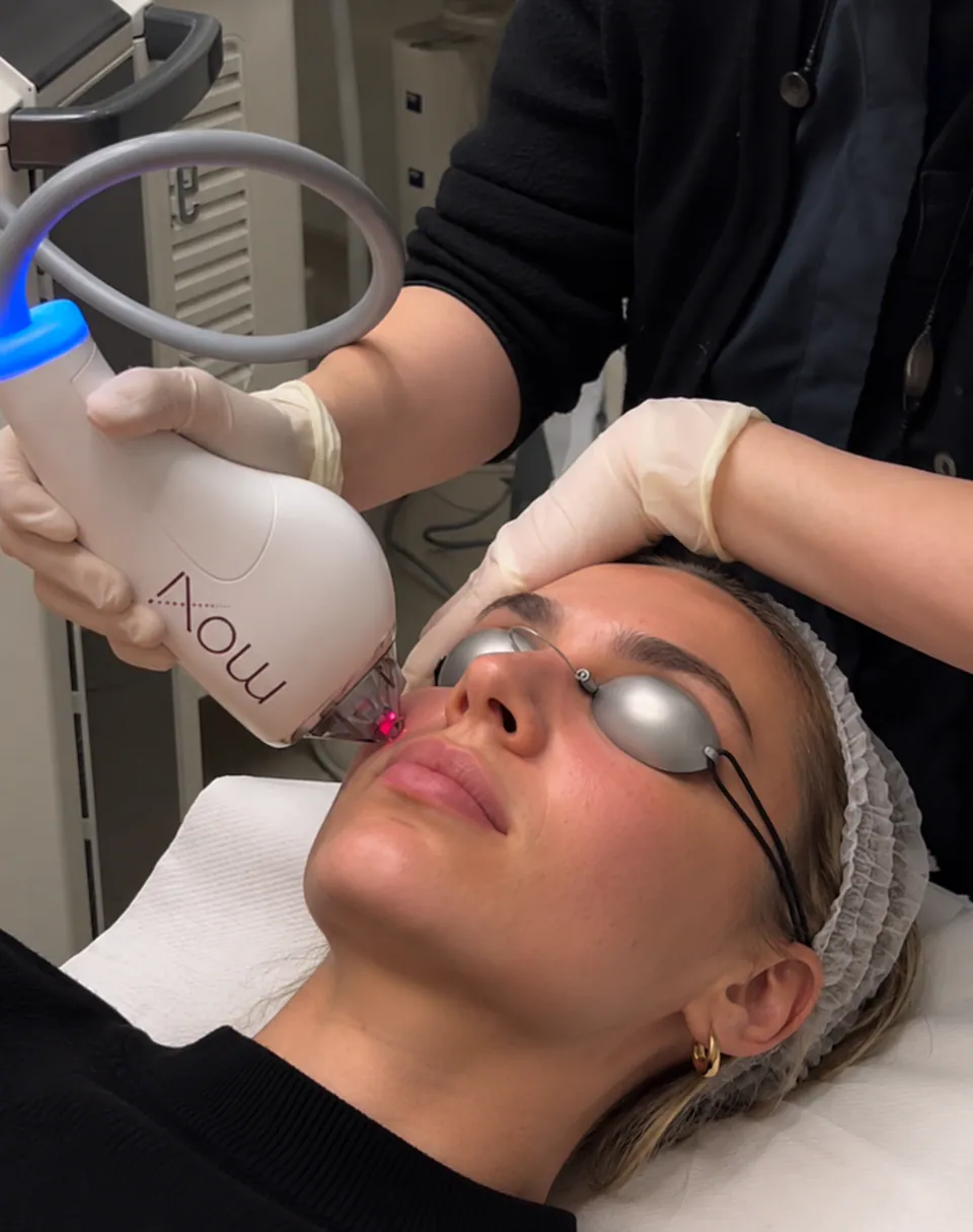 Close view of the Moxi handpiece treating a patient's cheek, its aiming beam visible on the skin