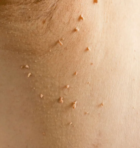 Close view of a neck with a cluster of small, skin-coloured skin tags