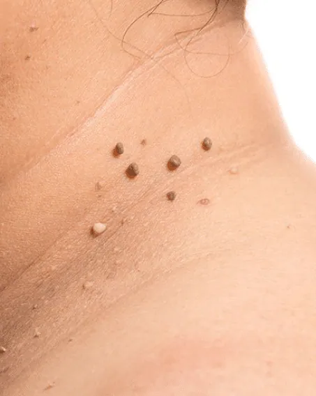 Close view of a neck with a group of small brown skin tags