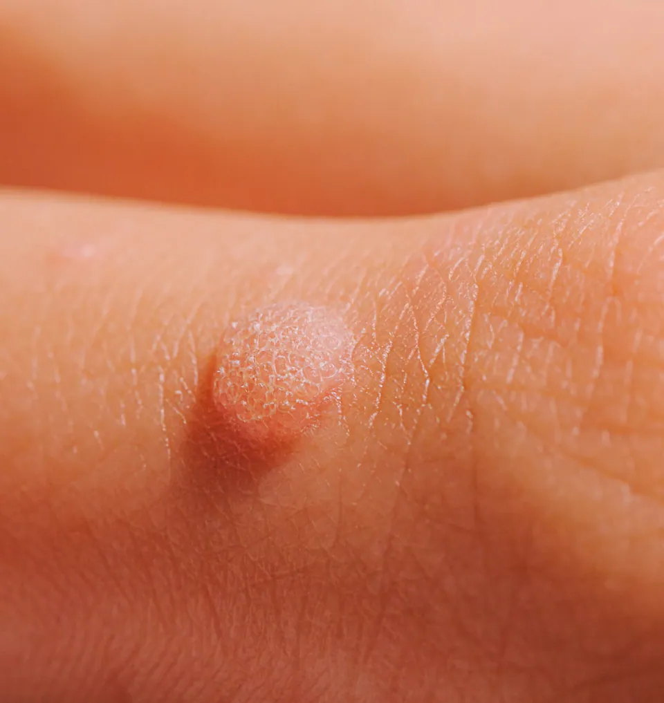 Close view of a rough, raised common wart on a finger