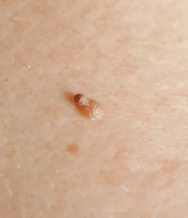 Close view of a single small skin tag on the skin
