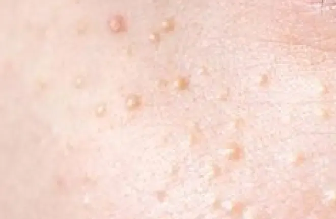 Close view of skin with clusters of small, pale, raised bumps