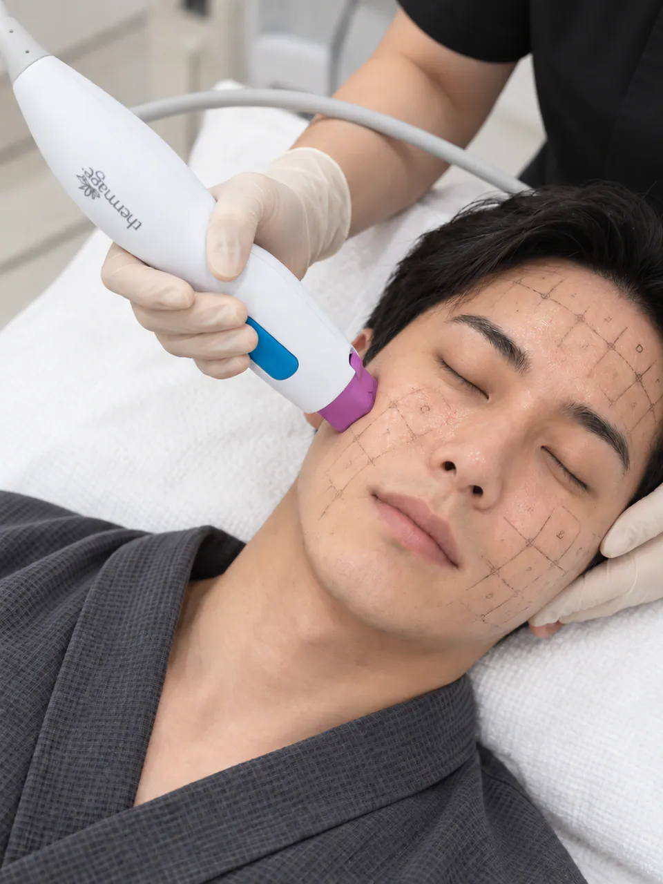 Close view of the Thermage handpiece being worked across a client's cheek over the marked treatment grid