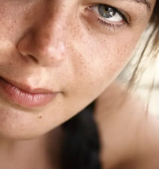 Close view of a woman's face with freckles and sun spots across the nose and cheeks