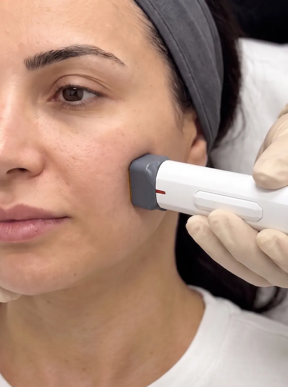 Close view of the XERF handpiece on a patient's cheek