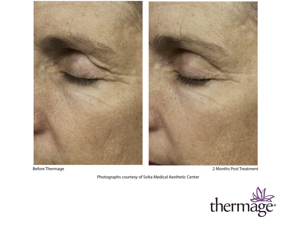Eye area before Thermage and 2 months post treatment