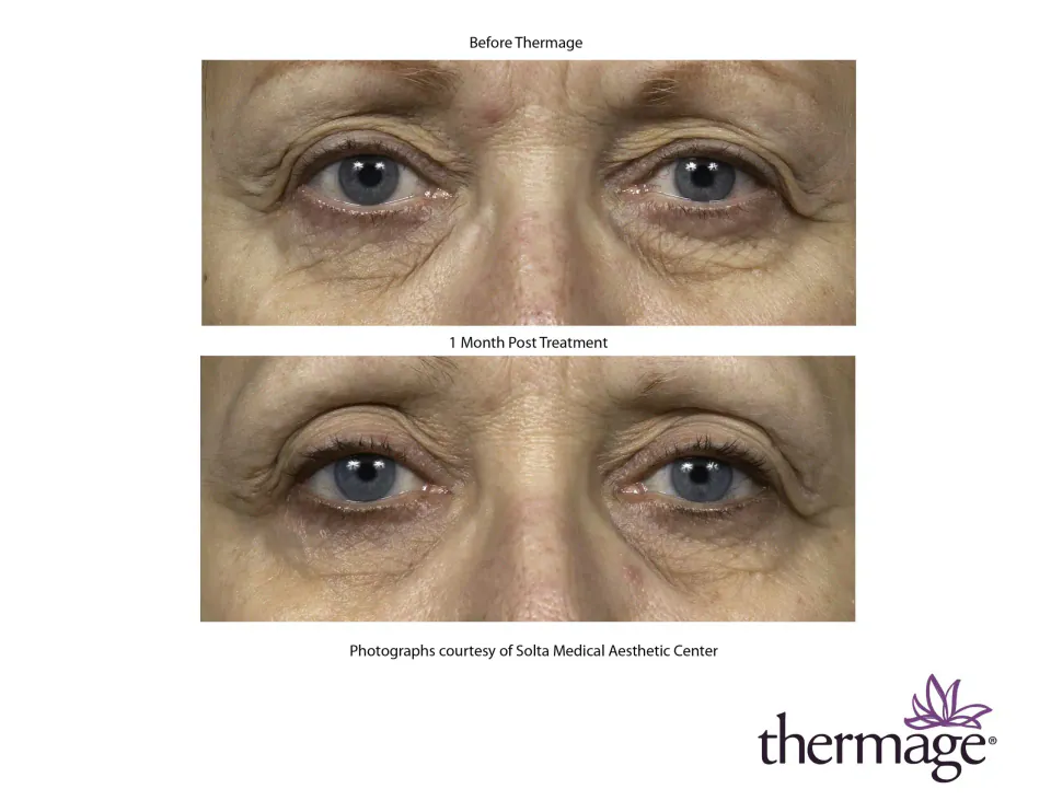 Eyes before Thermage and 1 month post treatment