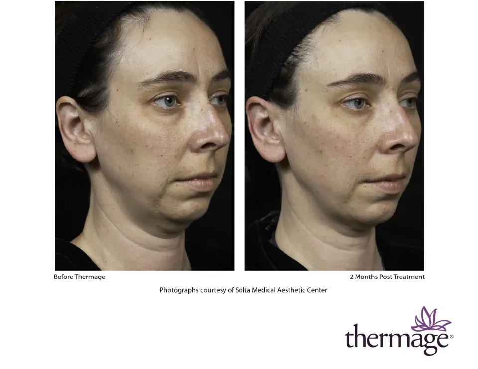 Face and jawline before Thermage and 2 months post treatment