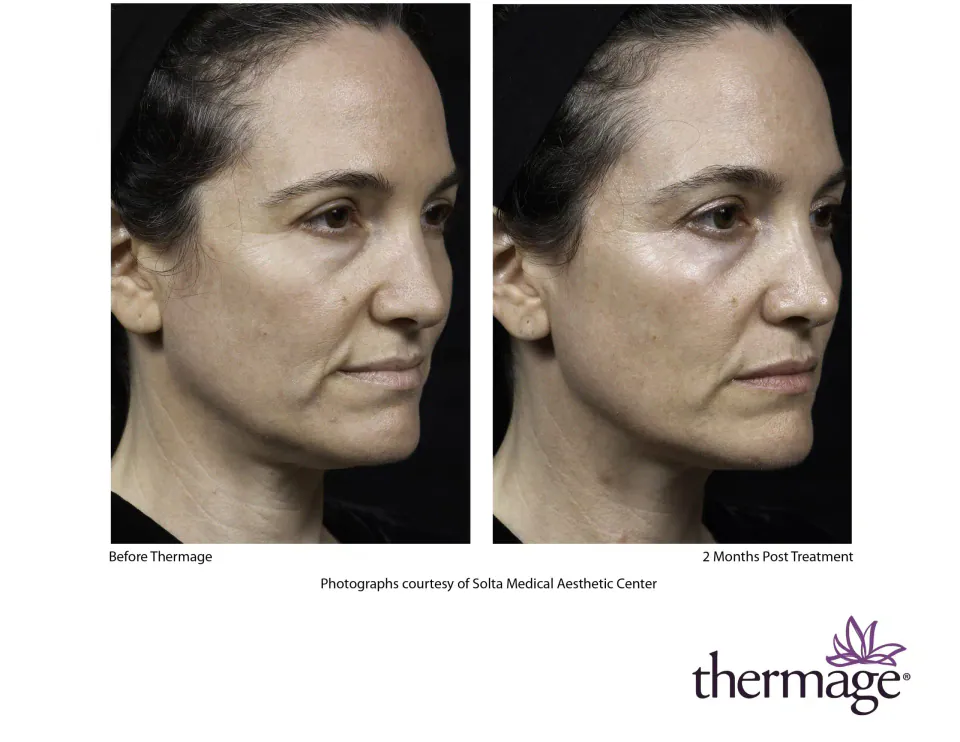 Face and jawline before Thermage and 2 months post treatment