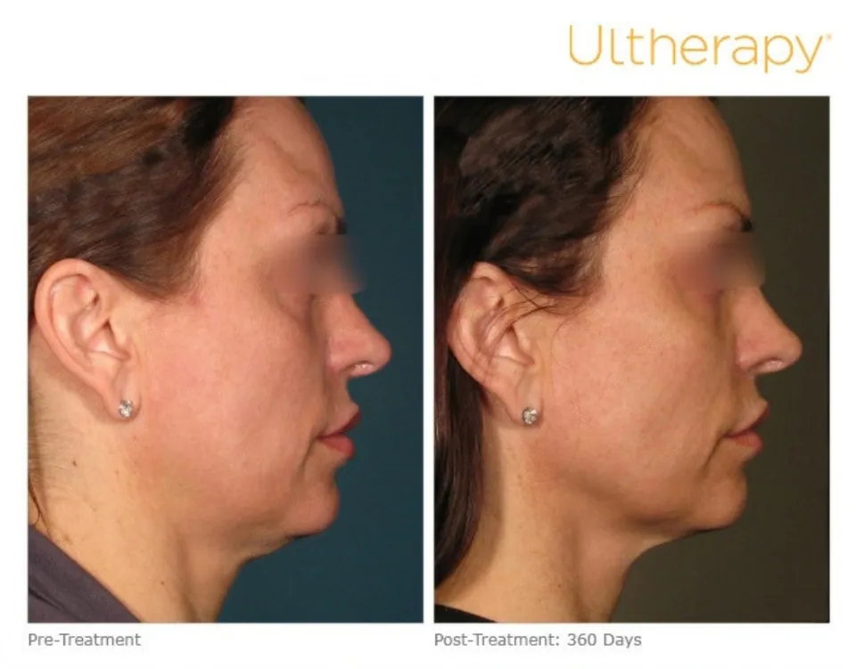 Face and jawline in profile before treatment and 360 days after, Ultherapy