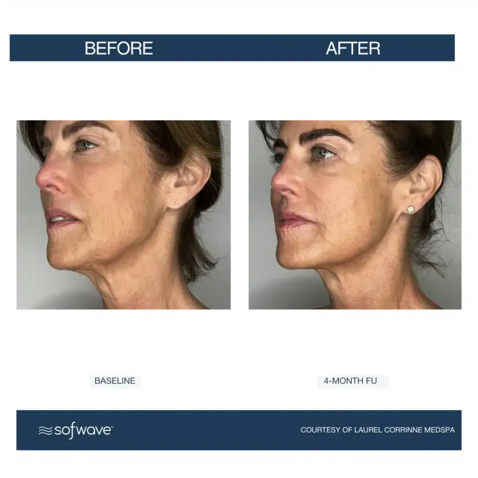 Face and neck at baseline and at 4-month follow-up, Sofwave