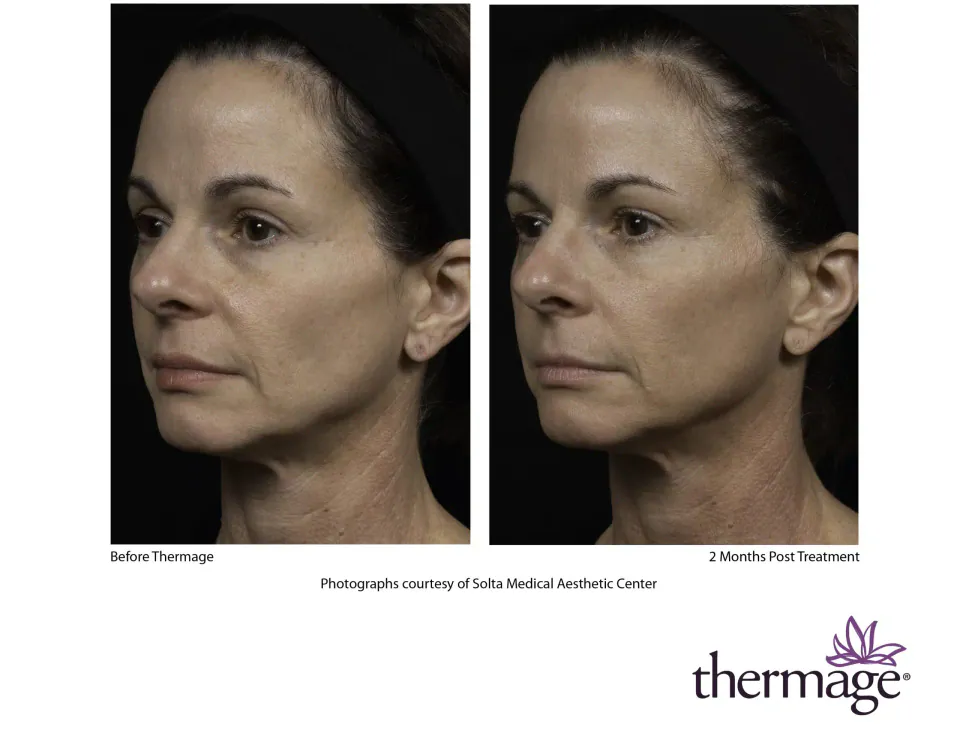 Face and neck before Thermage and 2 months post treatment