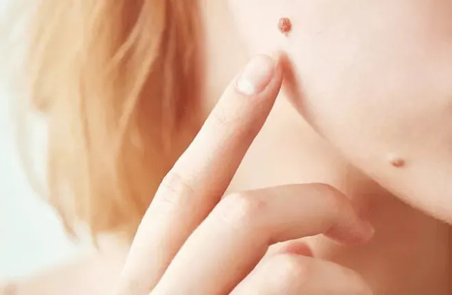 A fingertip pointing to small moles on the cheek and jaw