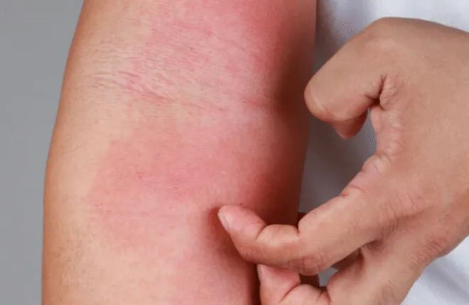 A hand scratching a red, inflamed patch of eczema on the forearm