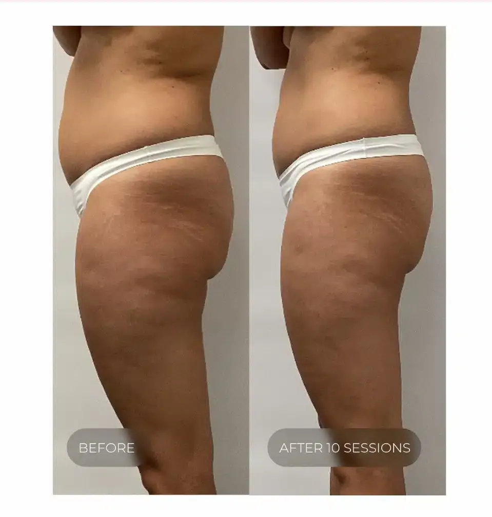 Hip, buttock and thigh before and after 10 sessions of LPG endermologie