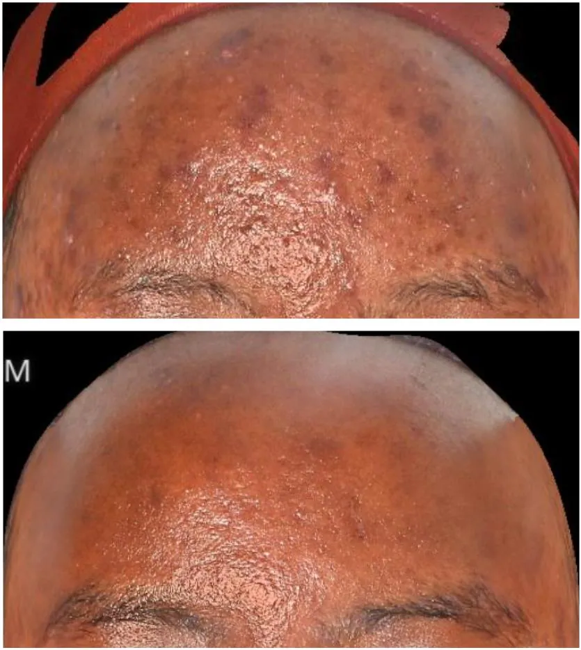 Hyperpigmentation before and after treatment at Dr Jinah Yoo Dermatology