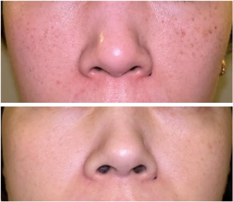 Hyperpigmentation before and after treatment at Dr Jinah Yoo Dermatology