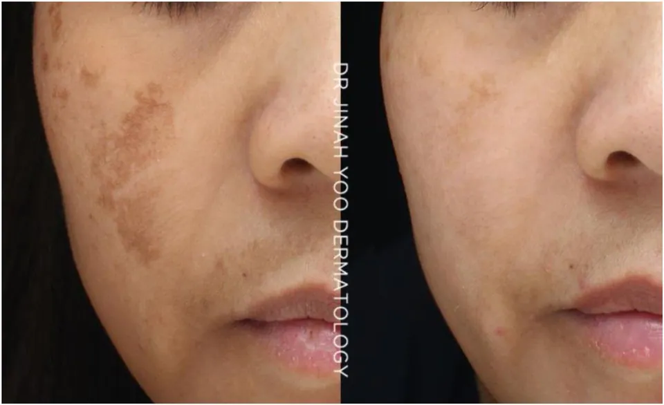 Hyperpigmentation before and after treatment at Dr Jinah Yoo Dermatology