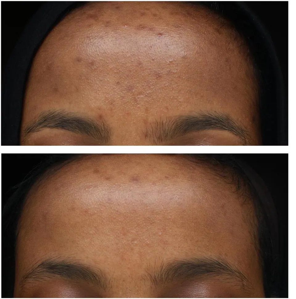 Hyperpigmentation before and after treatment at Dr Jinah Yoo Dermatology