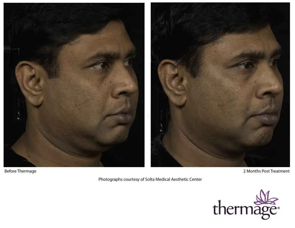 Jawline before Thermage and 2 months post treatment