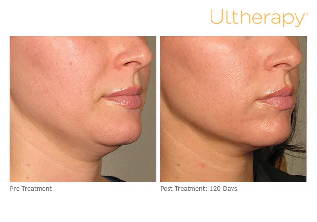 Jawline and chin before treatment and 120 days after, Ultherapy