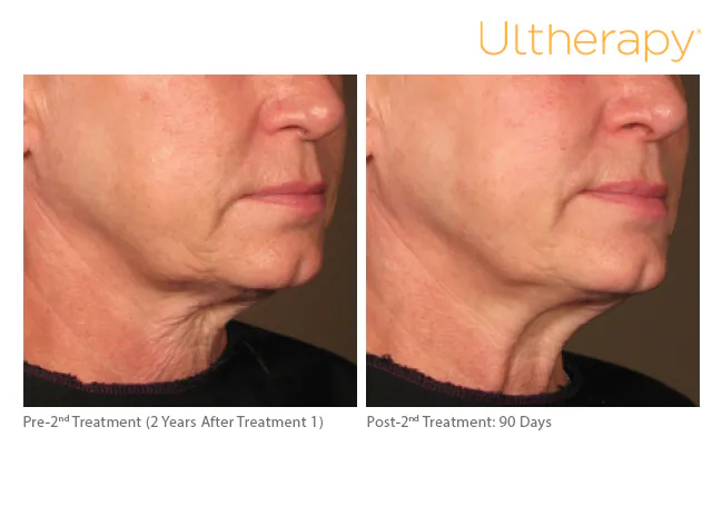 Jawline and neck before a second treatment and 90 days after, Ultherapy