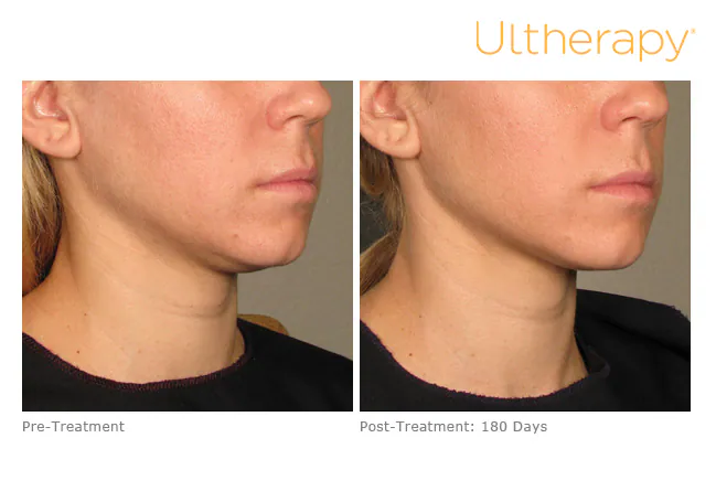 Jawline and neck before treatment and 180 days after, Ultherapy