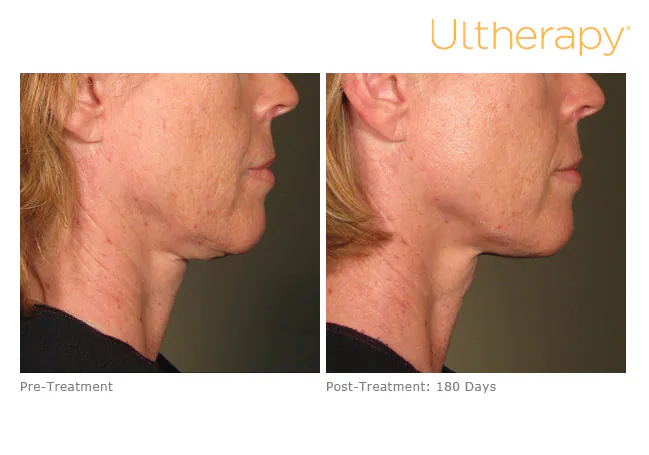 Jawline and neck before treatment and 180 days after, Ultherapy
