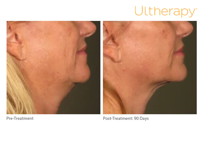 Jawline and neck before treatment and 90 days after, Ultherapy