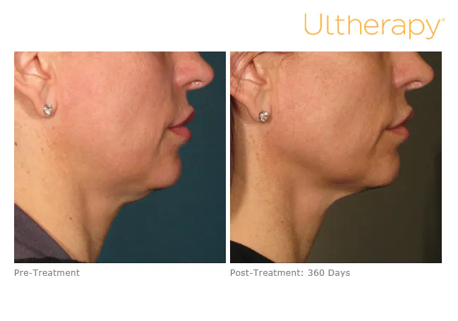 Jawline and neck in profile before treatment and 360 days after, Ultherapy
