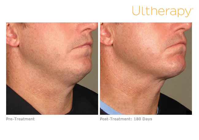 Jawline and under the chin before treatment and 180 days after, Ultherapy