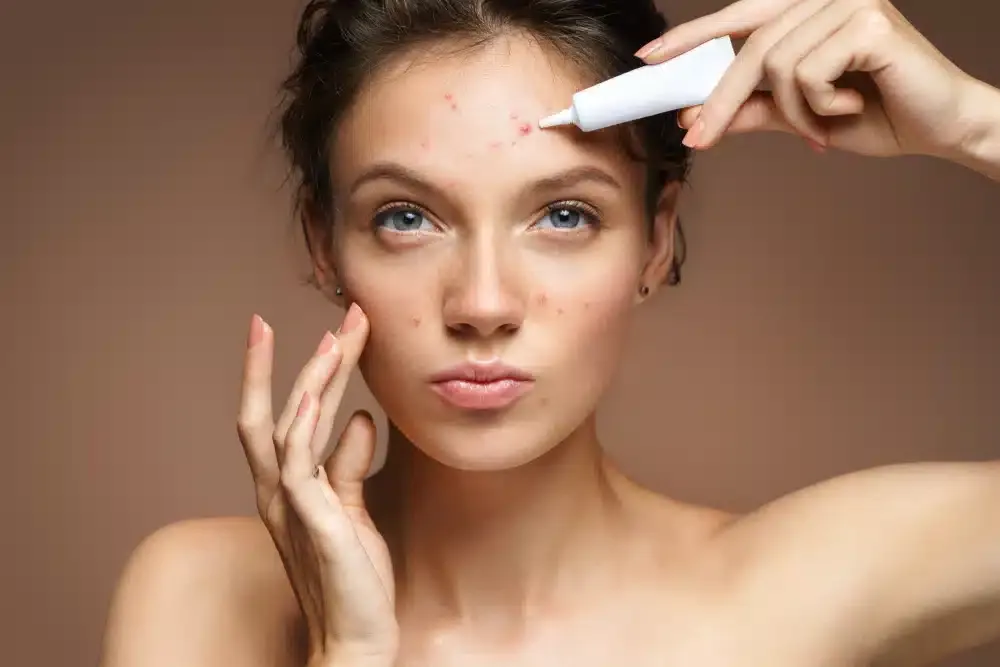 woman treating acne with the best acne treatment