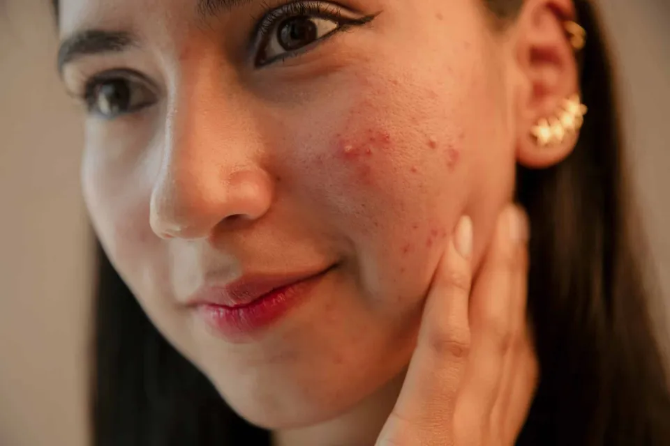 Acne, Dr Jinah Yoo