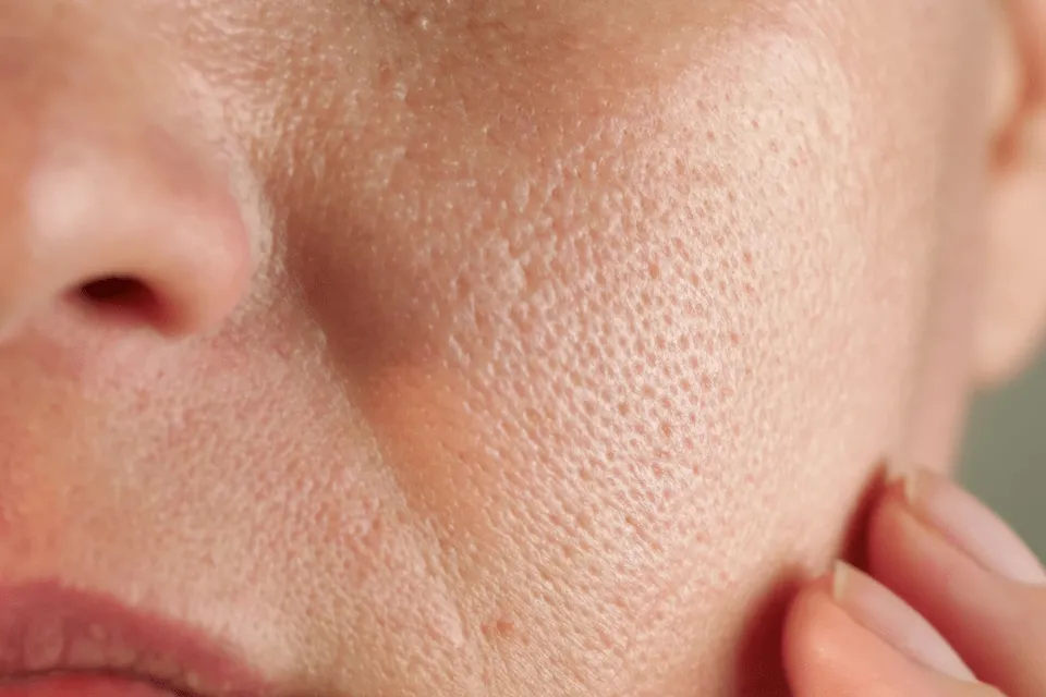 close up of large pores