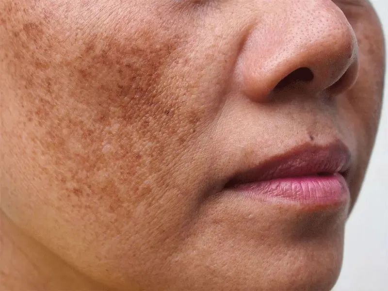 hyperpigmentation