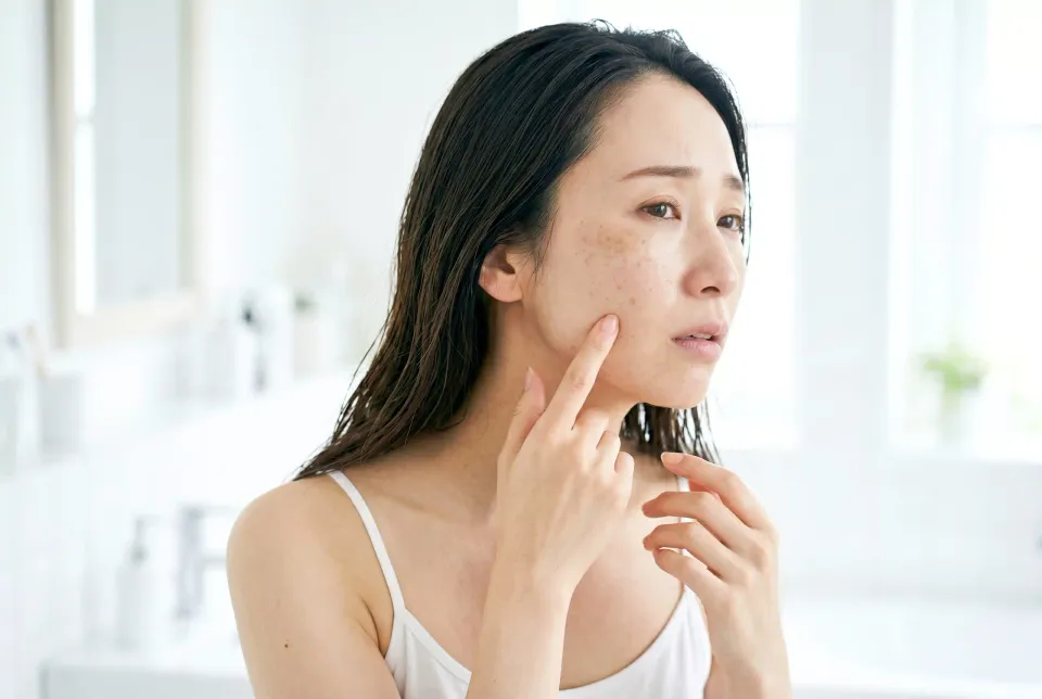 Hyperpigmentation in Skin of Colour: A Consultant Dermatologist’s Guide