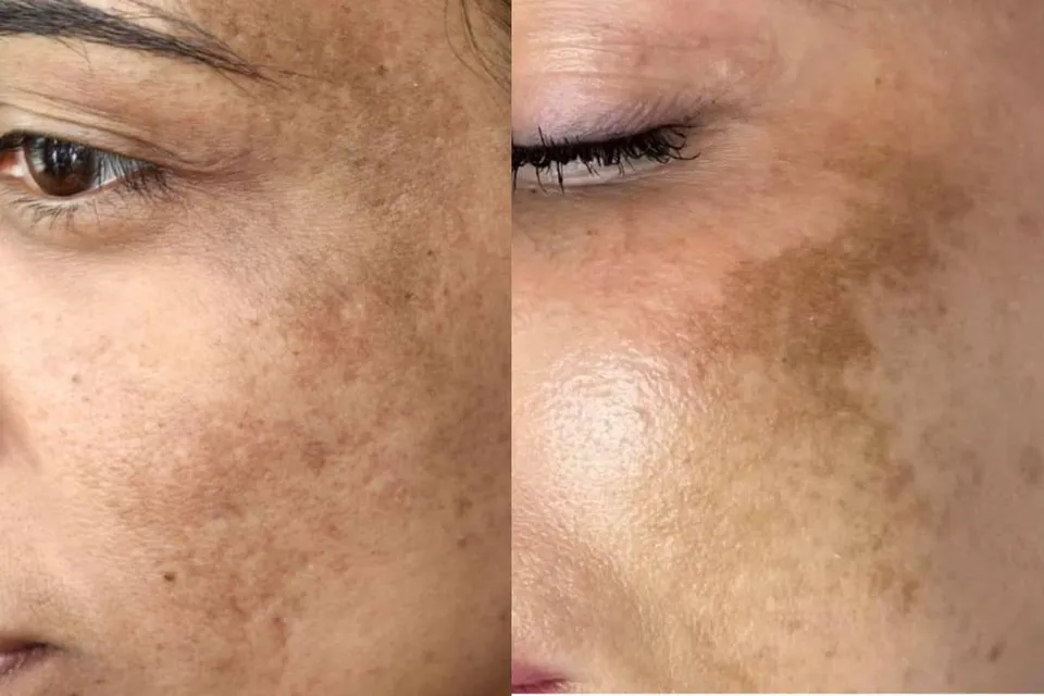 Melasma Treatments: How to Know Which One Is Right for You, Dr Jinah Yoo