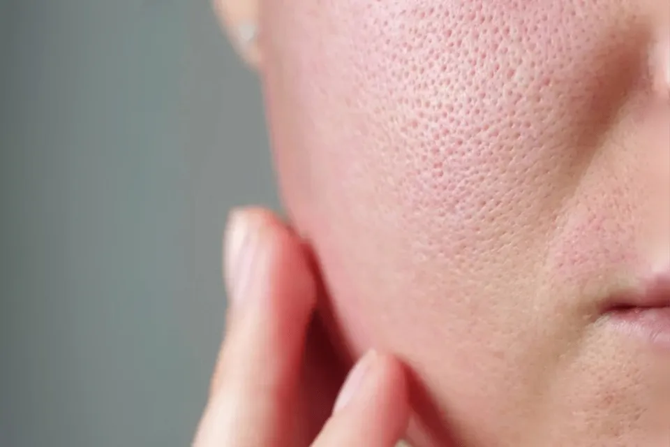Large pores on the face, Dr Jinah Yoo