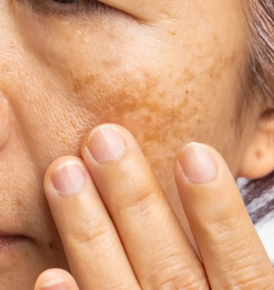 Melasma patches of brown pigmentation on a woman's cheek