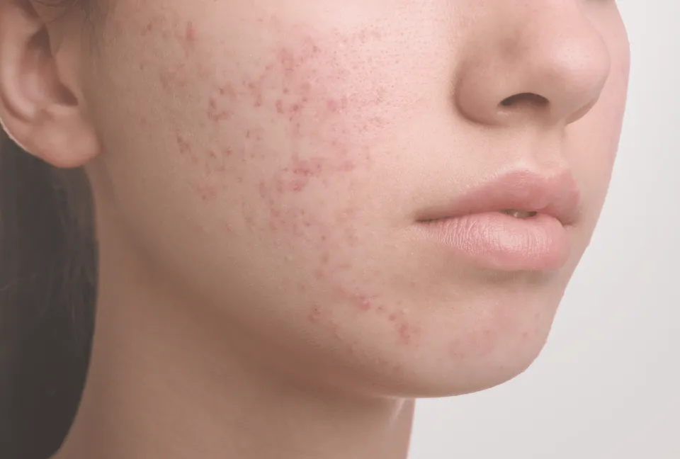 Oxygen Facial_ Refresh and Rejuvenate Your Acne Prone Skin