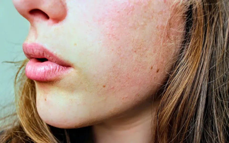 close up of a woman showing what is papulopustular rosacea
