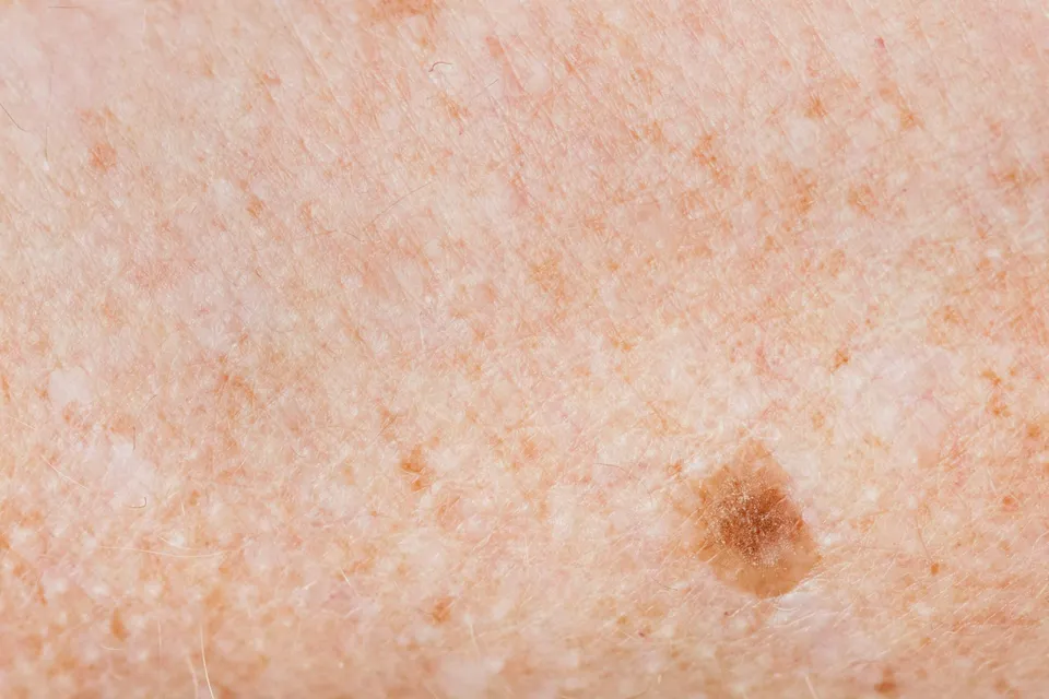 Pigmentation, Dr Jinah Yoo