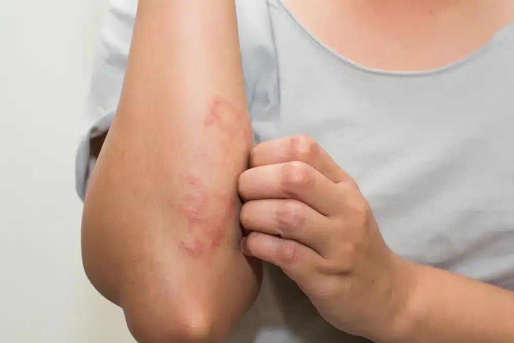 a woman scratching the area under elbow due to a visible rash