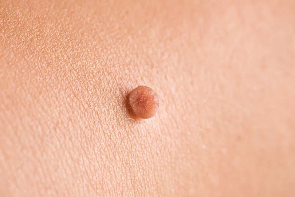 Skin Tag Removal in London: Safe Removal and What to Expect