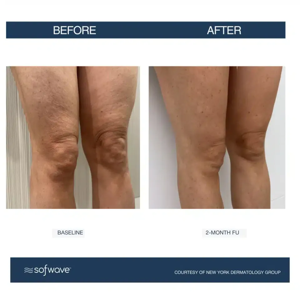 Knees and thighs at baseline and at 2-month follow-up, Sofwave