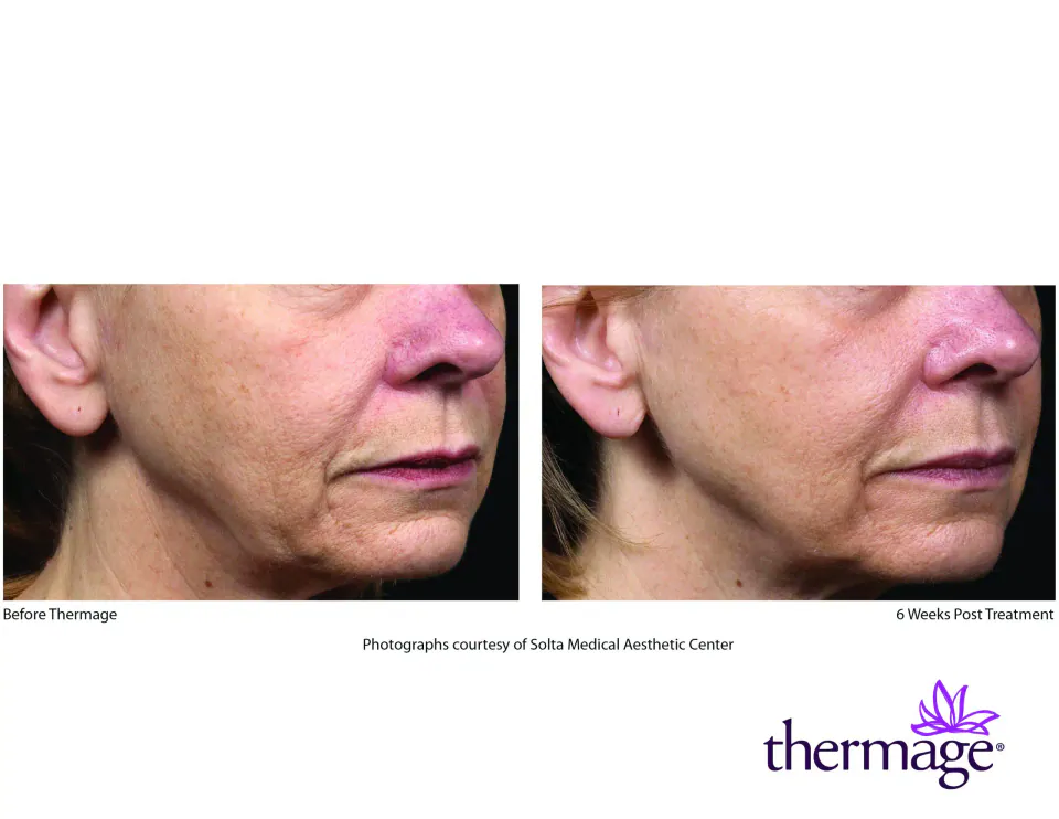 Lower face before Thermage and 6 weeks post treatment