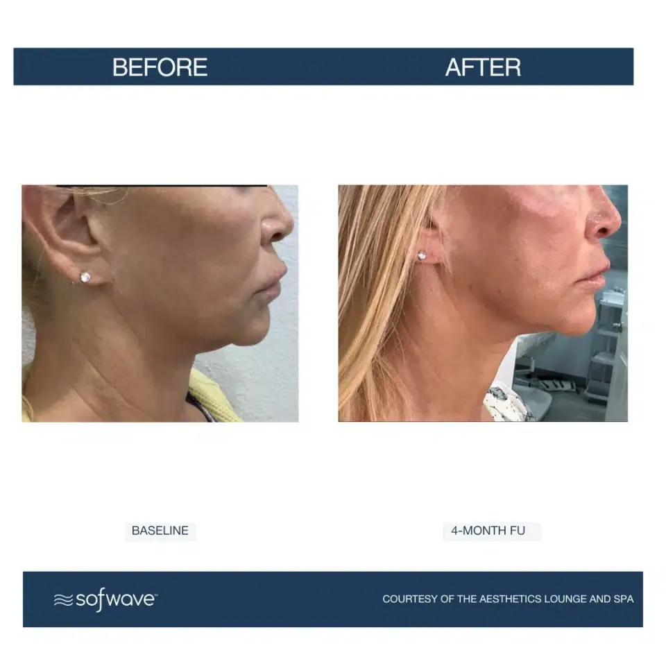 Neck and jawline at baseline and at 4-month follow-up, Sofwave