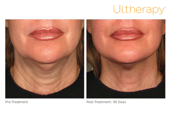 Neck and under the chin before treatment and 90 days after, Ultherapy